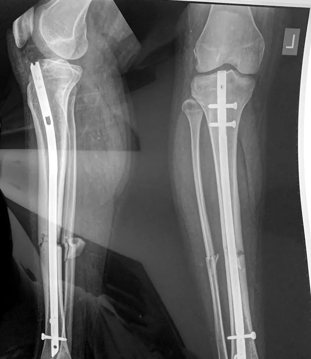 صورة شعاعية للساق بعد تثبيت كسر بمسمار نخاعي